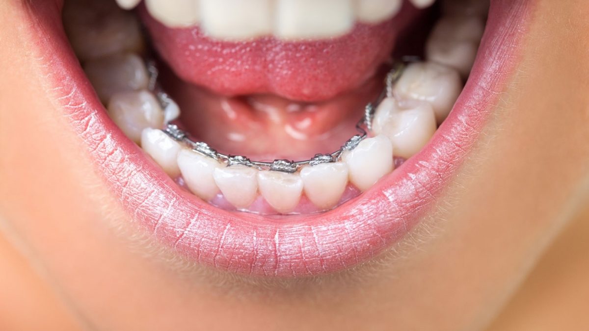 ارتودنسی ثابت دندان در نکودنت