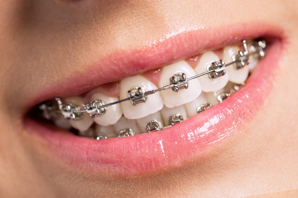 ارتودنسی دندان در کلینیک نکو
