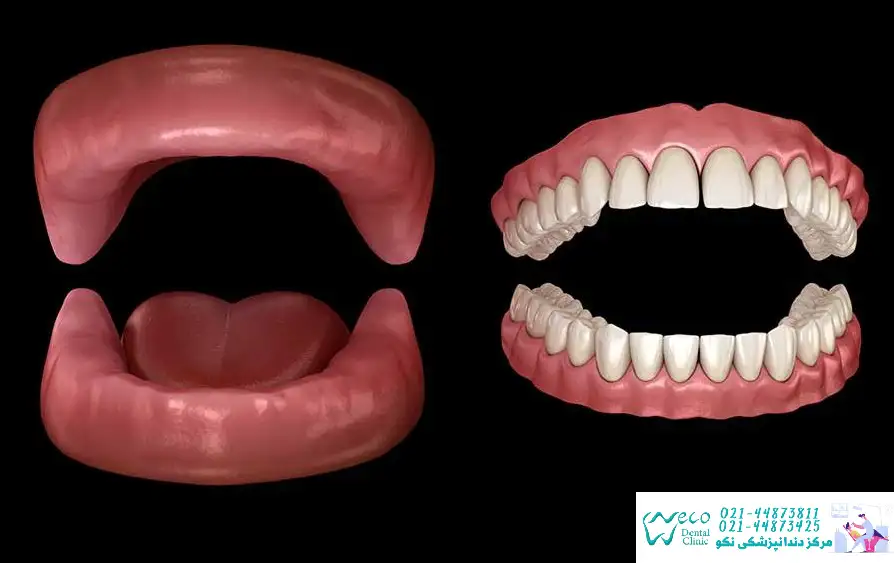 استفاده از فلیپر دندان برای جایگزینی دندان