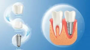 دلایل ایمپلنت کردن دندان