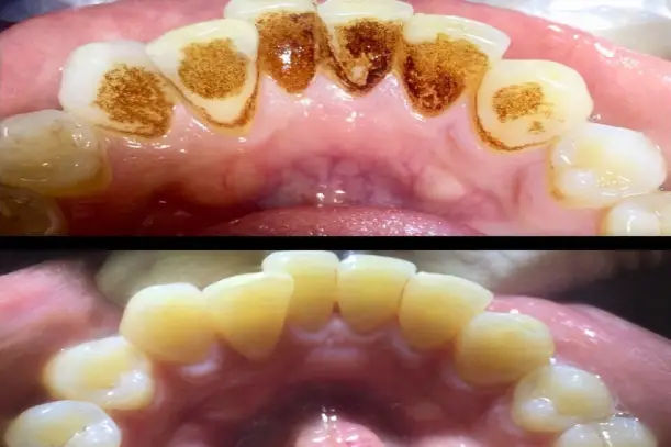 نمونه کار قبل و بعد جرم گیری دندان