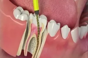 عصب کشی دندان درکلینیک نکو