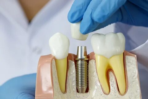 اجزای اصلی ایمپلنت دندان