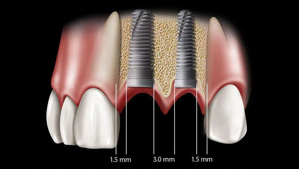 نکات مهم برای انتخاب پروتز دندان