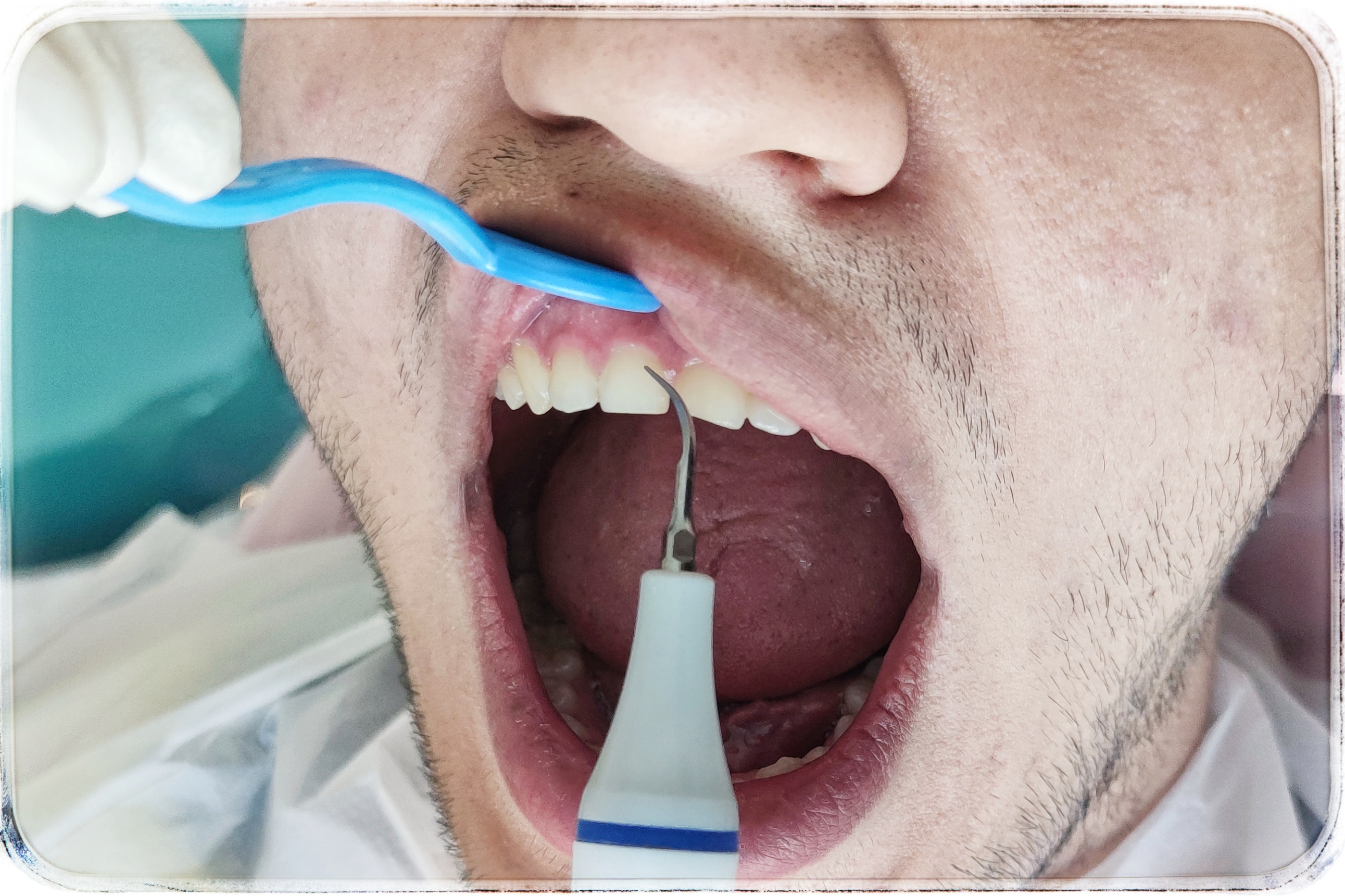 پریودنتیت در جرم گیری دندان