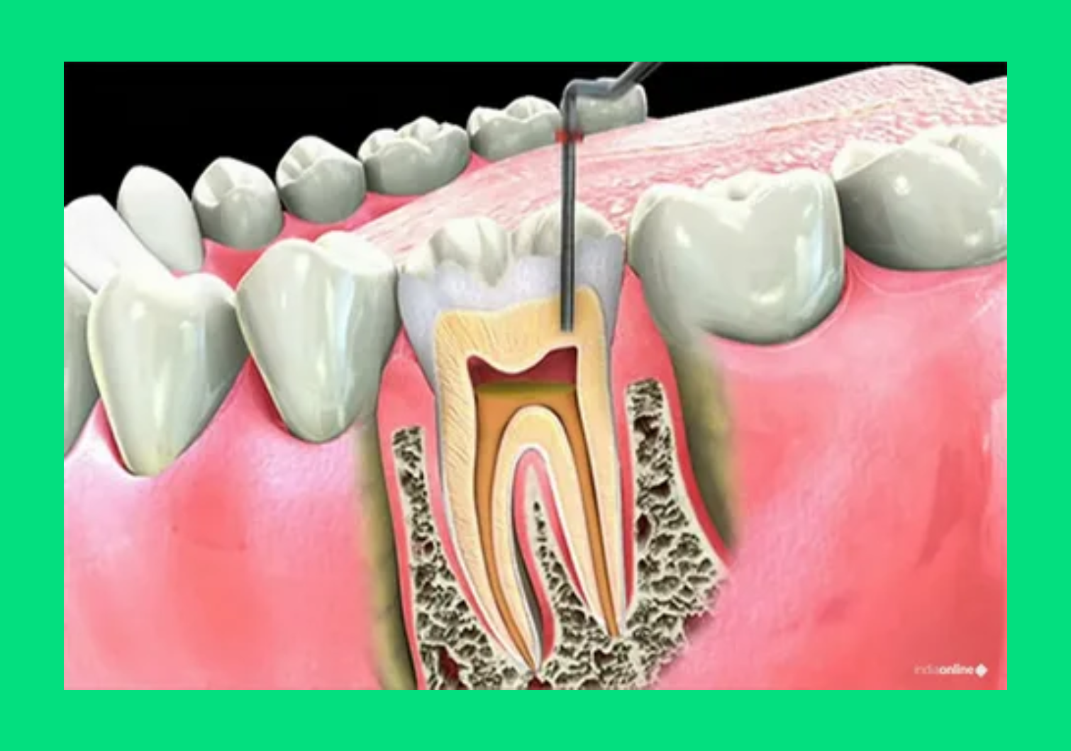 درمان عصب کشی ​دندان