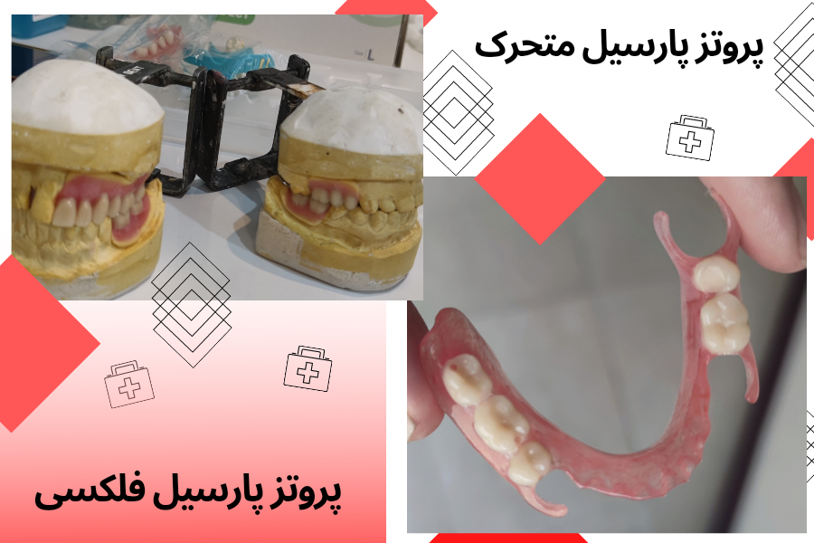پروتز دندانی متحرک چیست