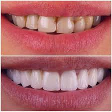 نمونه کار قبل و بعد از لمینت دندان