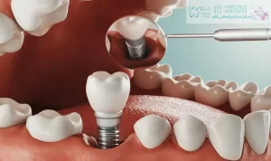 تصویر ایمپلنت دندان و اتصالات آن