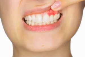 آبسه دندانی چیست؟