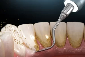 آیا جرمگیری به دندانها آسیب میزند؟
