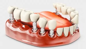 تفاوت پروتز دندانی ثابت و متحرک