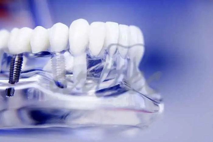 سوالات متداول درباره ایمپلنت دندان