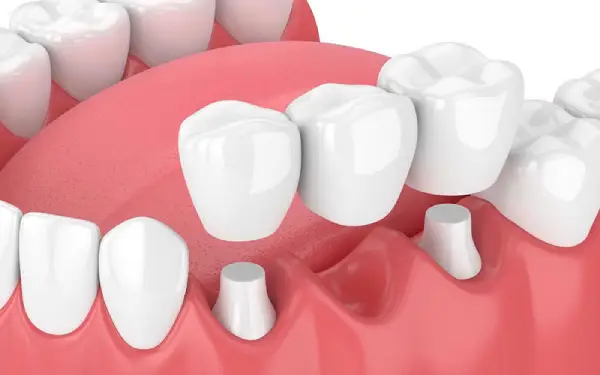 پروتز دندانی ثابت و متحرک