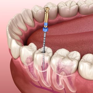 انتخاب بهترین دندانپزشک برای عصب کشی دندان در غرب تهران