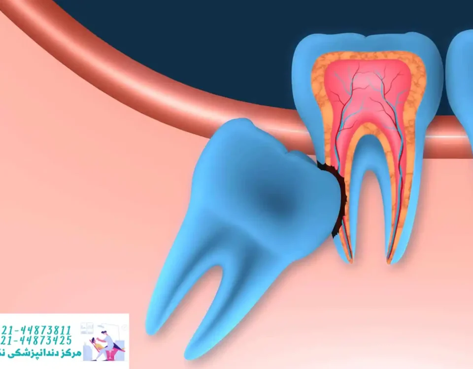 تصویر دندان عقل نهفته