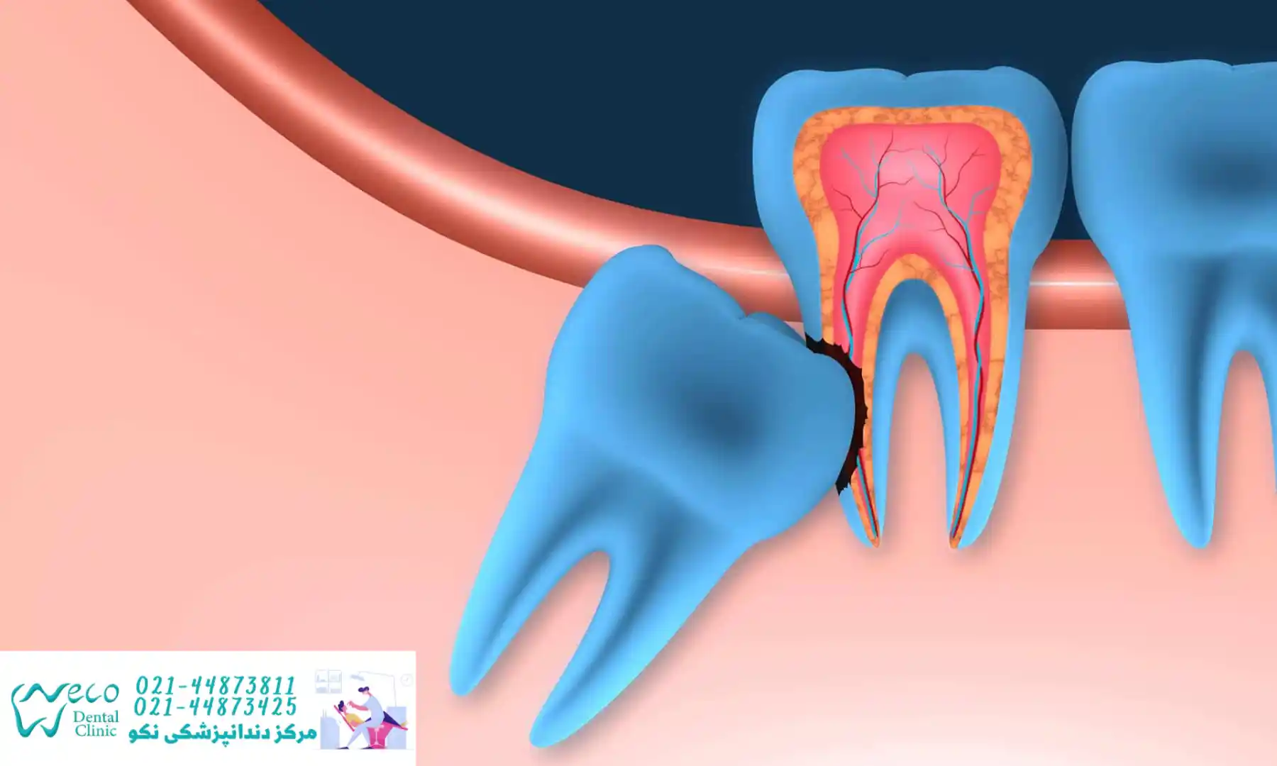 تصویر دندان عقل نهفته