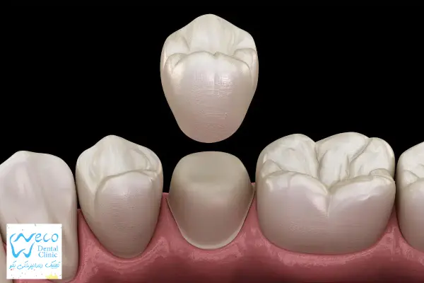 تراش دندان برای روکش
